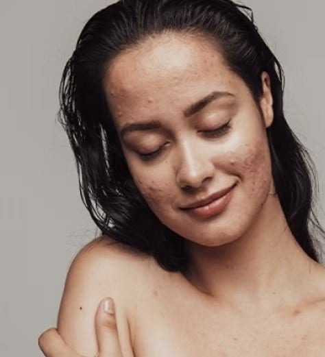 lady with acne
